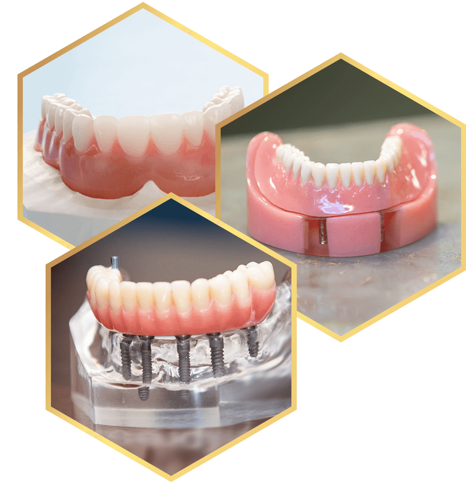 all3 implant denture options allonx fixed removable1