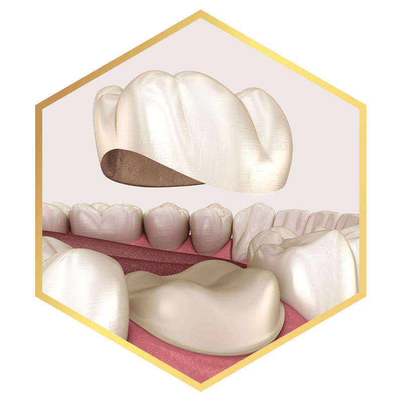 dental crowns with stylized border3