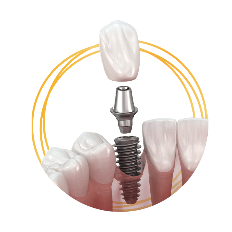 dental implant stylized 3d