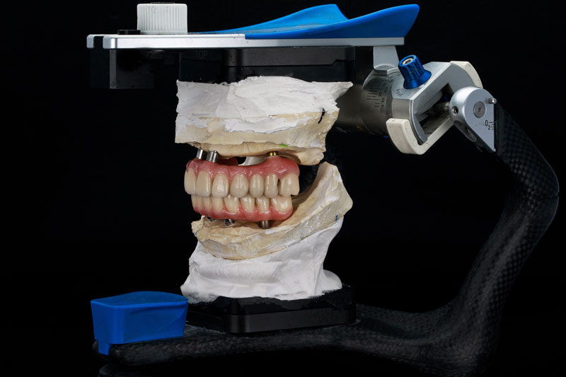 An excellent composition of a special dental of an articulator with prostheses of the upper and lower jaw on a black background