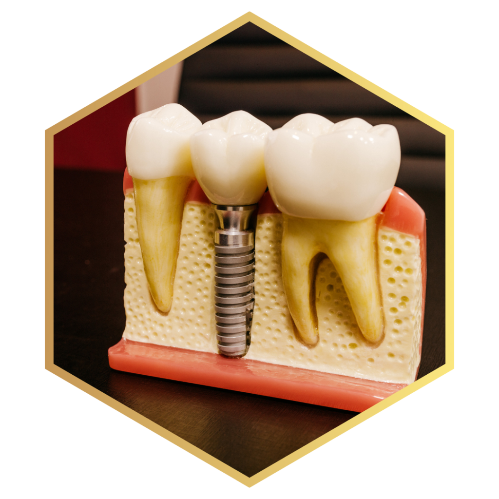 Image of a dental implant model