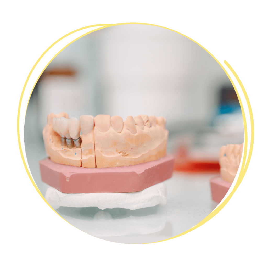 Image of a dental implant in a model