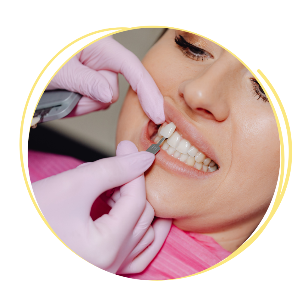 veneer matching